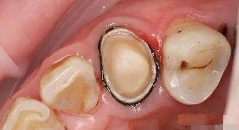 烤瓷牙套里的牙会烂吗？（烤瓷牙有什么优点和缺点？）(图3)